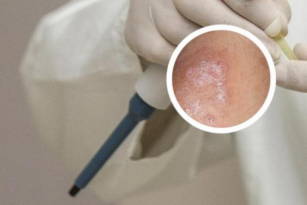 长春市哪治疗银屑病好-长春治疗银屑病医院哪家好