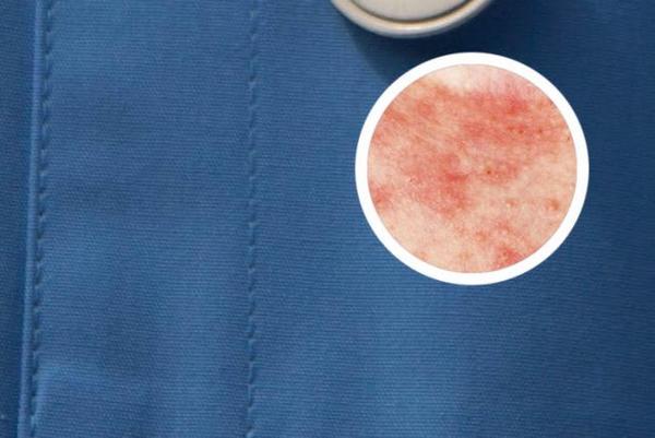 长春治银屑病的中医-长春银屑病治疗哪家医院好