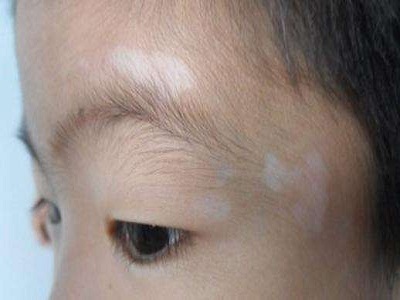 长春哪家医院看小孩白癜风好-长春市哪里看白癜风看的好