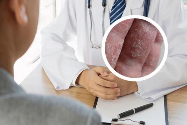 去长春博润医院怎么走-长春治疗银屑病有没好方法