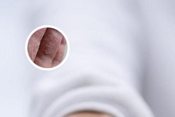 长春博润皮肤病医院治皮肤病怎么样-长春银屑病可以治好吗