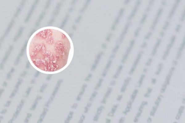 长春博润口碑好吗-长春银屑病治疗医院