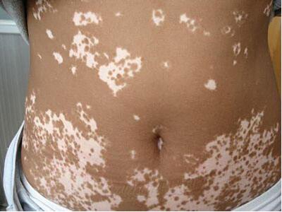 泛发型白癜风科