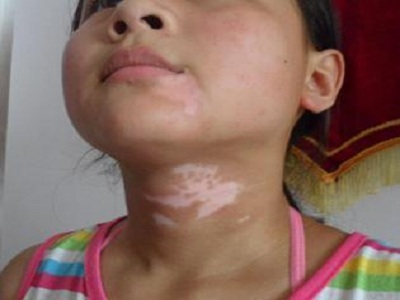 节段型白癜风科