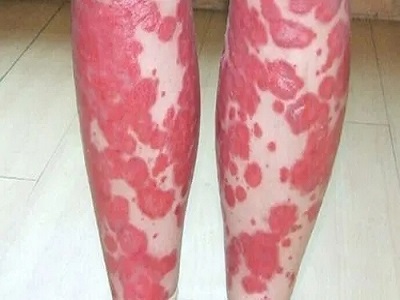 红皮型银屑病科