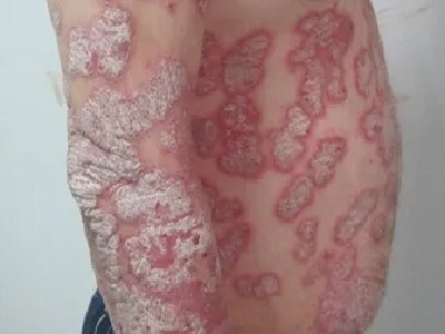 脓包型银屑病科