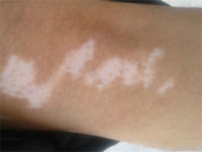 长春白癜风治疗医院-长春专治白癜风医院怎么选