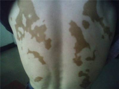 长春博润皮肤病医院治疗-长春十佳白癜风正规医院