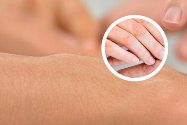 长春哪里治银屑病好-长春能用中医治银屑病的医院