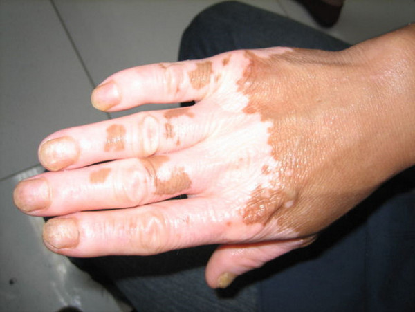 长春专业治白癜风医院-长春专门看白癜风的医院