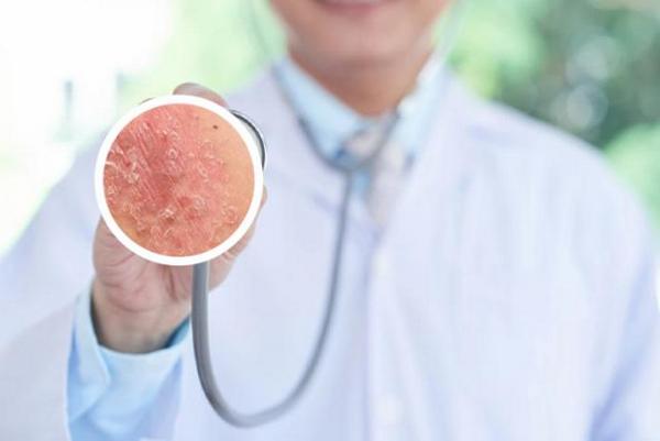 长春银屑病十佳医院-长春有哪个医院可以治疗银屑病