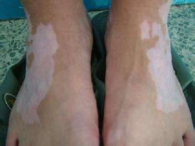 长春哪间白癜风医院好-长春中医治疗白癜风好的医院