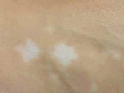 长春博润皮肤病医院好么-长春专业白癜风医院哪里好