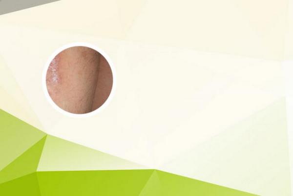 长春博润皮肤病医院靠谱吗-长春看银屑病效果好的医院