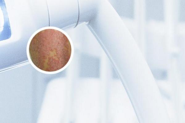 长春银屑病治疗在哪家医院好-长春有银屑病治疗医院吗