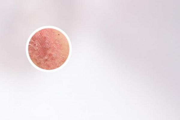 长春哪家医院能看好银屑病-长春专业银屑病医院哪家强