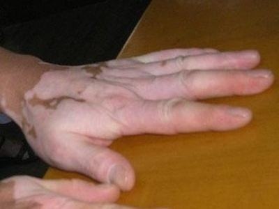 长春治疗白癜风到哪里-长春白癜风治疗好的医院