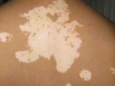 长春白癜风医院的地址在哪里-长春有没有治疗白癜风的好医院