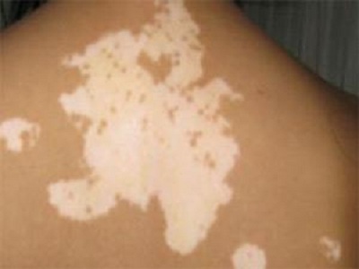 长春博润皮肤病医院的治疗方法-长春市能治疗白癜风的