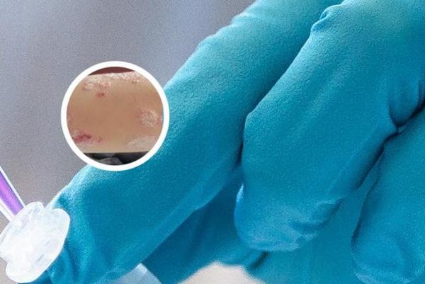 长春哪家医院专治银屑病-长春哪所医院医治银屑病好