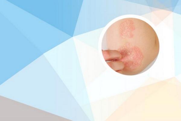 长春银屑病医院位于哪里-长春银屑病哪里看的好