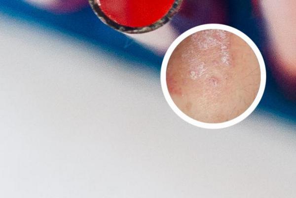 长春博润皮肤病医院电话地址-长春什么医院治银屑病好