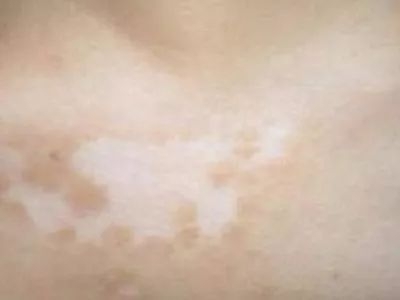 长春博润皮肤病医院的治疗费用-长春专业白癜风医院哪家好