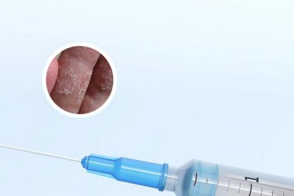 长春去哪里看银屑病好-长春有什么医院可以治疗银屑病