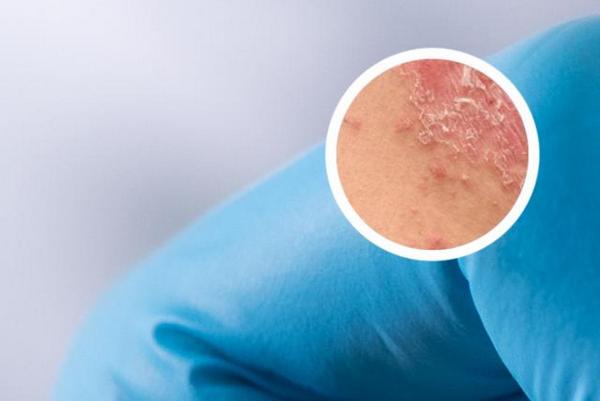 长春博润皮肤病医院正规吗-长春银屑病怎样治疗