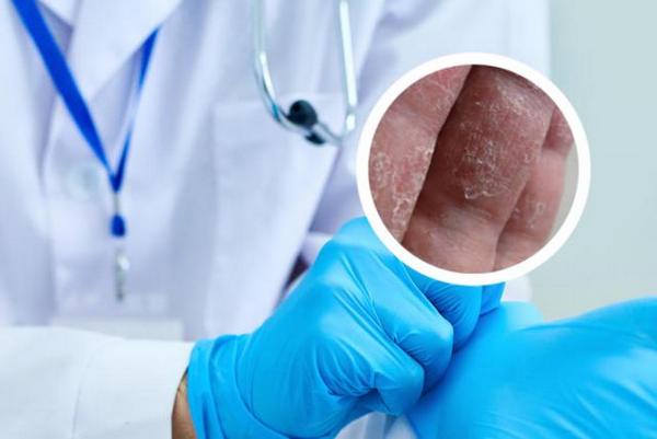 长春哪家治疗银屑病效果好-长春哪里可以治银屑病