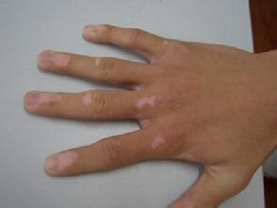 长春什么医院治白癜风正规-长春治疗白癜风到哪家医院比较好