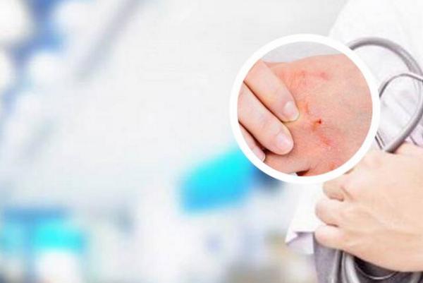 长春市哪个银屑病医院比较好-长春治疗银屑病的地方