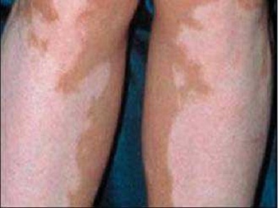 长春治白癜风医院哪个好-长春白癜风医院哪个治的好