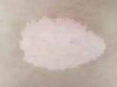 长春专业白癜风医院哪所技术好-长春市有多少家治白癜风的医院