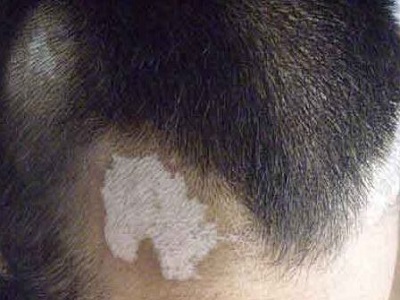 长春看白癜风医院哪个好-长春治疗白癜风正规专业医院