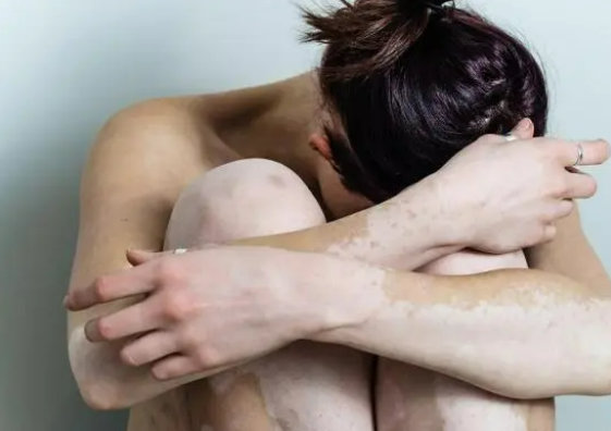 长春白癜风的医院有哪些-长春哪里治白癜风