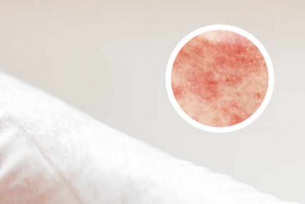 长春银屑病到哪里治疗-长春哪家看银屑病好