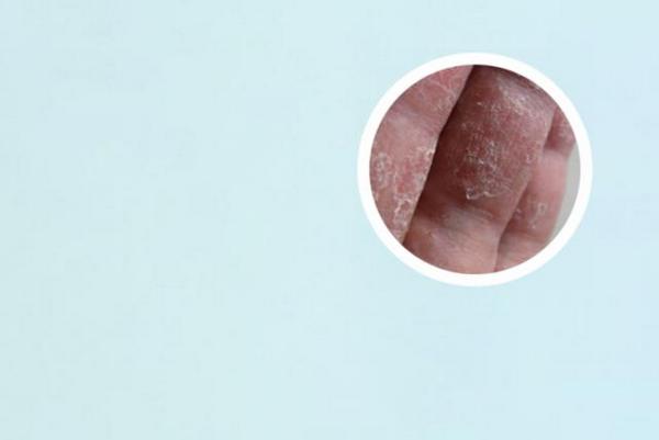 长春头部银屑病的治疗方法-长春治疗银屑病好的银屑病医院