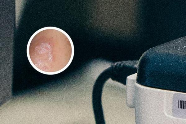 长春好银屑病医院在哪里-长春银屑病治疗好专业医院