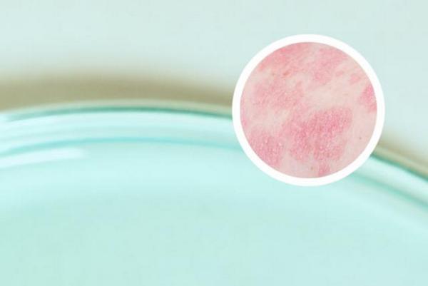 长春在哪家医院可以治银屑病-长春银屑病哪家医院治疗好