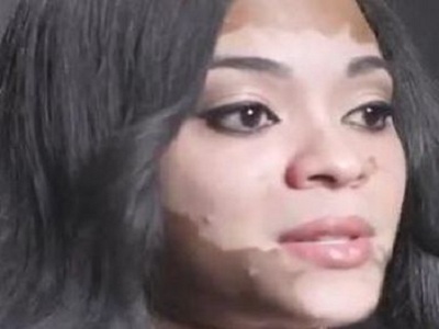 长春哪个医院治疗白癜风效果比较好-长春白癜风初期怎样治疗