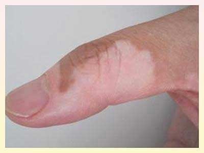 长春哪里治白癜风专业-长春专业白癜风医院哪家强