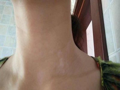 长春治白癜风有效的医院-长春正规的白癜风医院