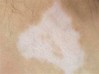 长春有没有治白癜风的好医院-长春治白癜风哪家好