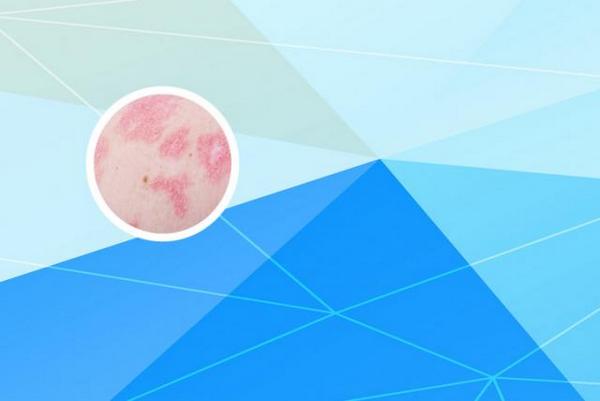 长春银屑病医院哪家技术好-长春哪里可以治疗银屑病