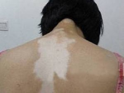 长春好的能治白癜风的医院有哪些-长春白癜风医院