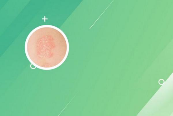 长春哪家医院治银屑病-长春中医看银屑病在哪里