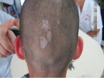 长春看白癜风医院路线-长春治疗白癜风哪家好