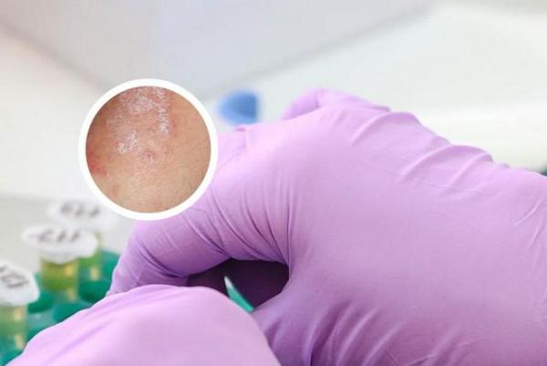 长春专治银屑病的好医院-长春专业银屑病医院