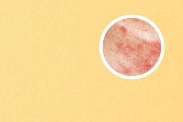 长春哪里治疗银屑病好-长春好的治疗银屑病的医院